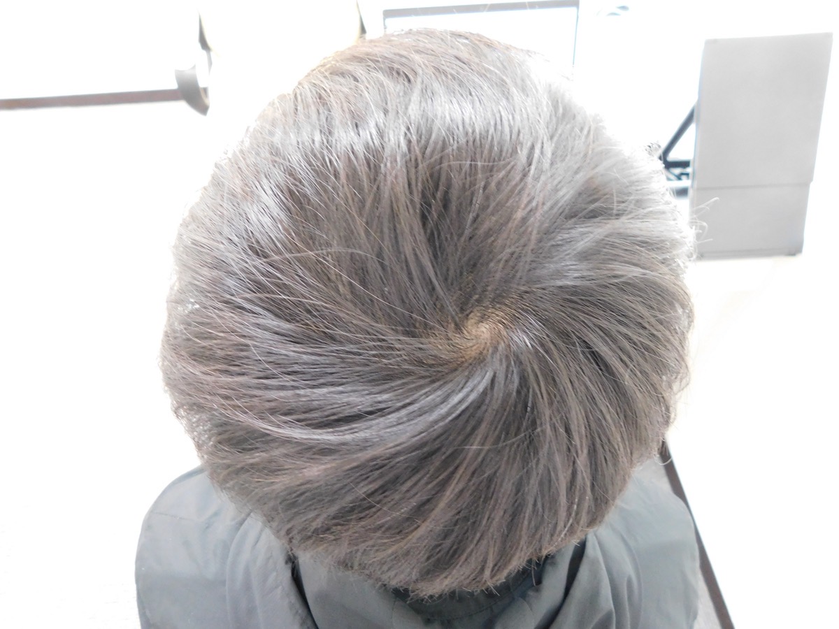 山形県天童市で実績豊富なAGAクリニックの薄毛改善事例（20代男性・3ヶ月後）