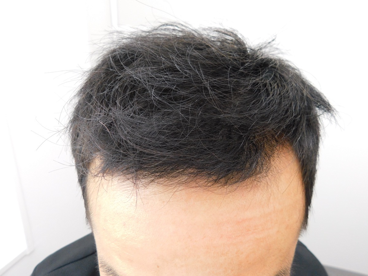 薄毛の改善事例（30代男性・3ヶ月後）