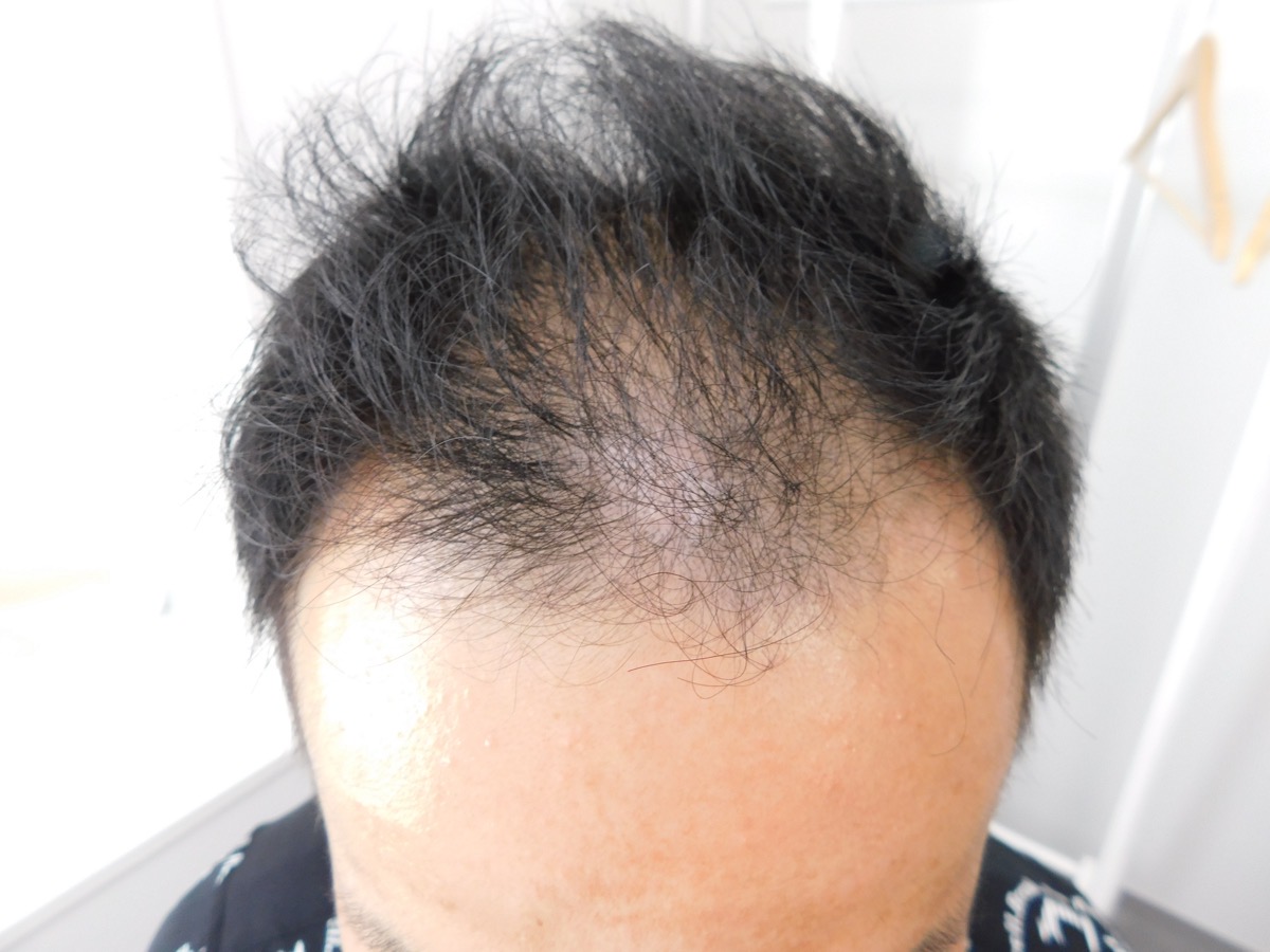 薄毛の改善事例（30代男性・来院時）