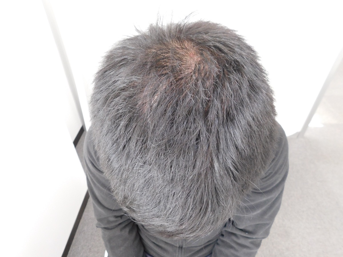 山形県南陽市で実績豊富なAGAクリニックの薄毛改善事例（30代男性・6ヶ月後）