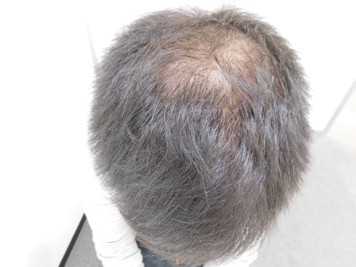 薄毛の改善事例（30代男性・来院時）