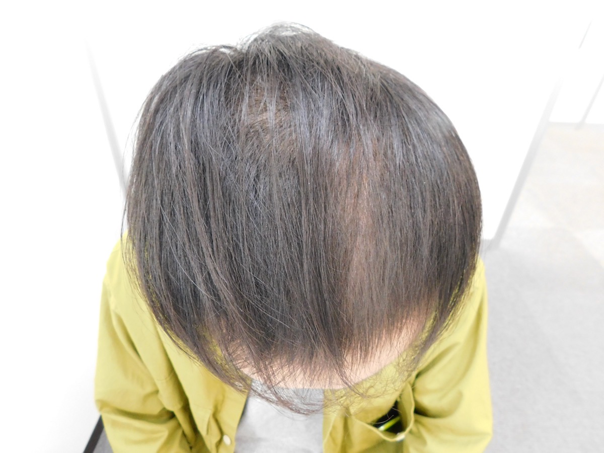 山形県天童市で実績豊富なAGAクリニックの薄毛改善事例治療6ヶ月後