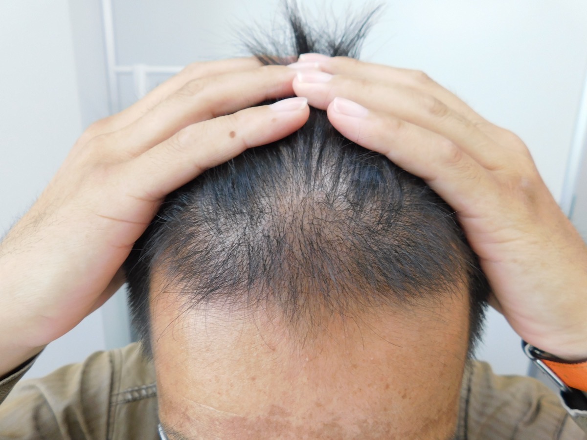 山形県上山市で実績豊富なAGAクリニックの薄毛改善事例（40代男性・3ヶ月後）