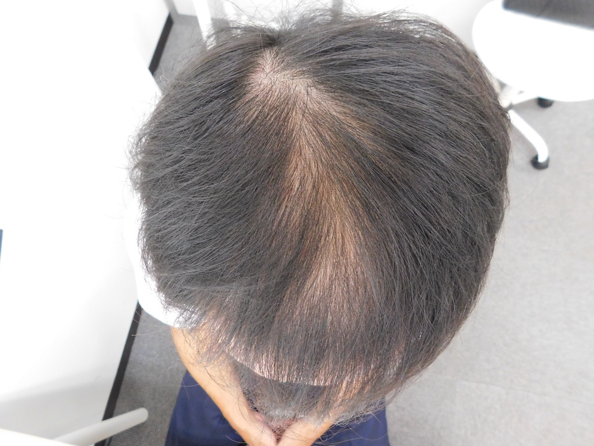 薄毛の改善事例（50代男性・来院時）