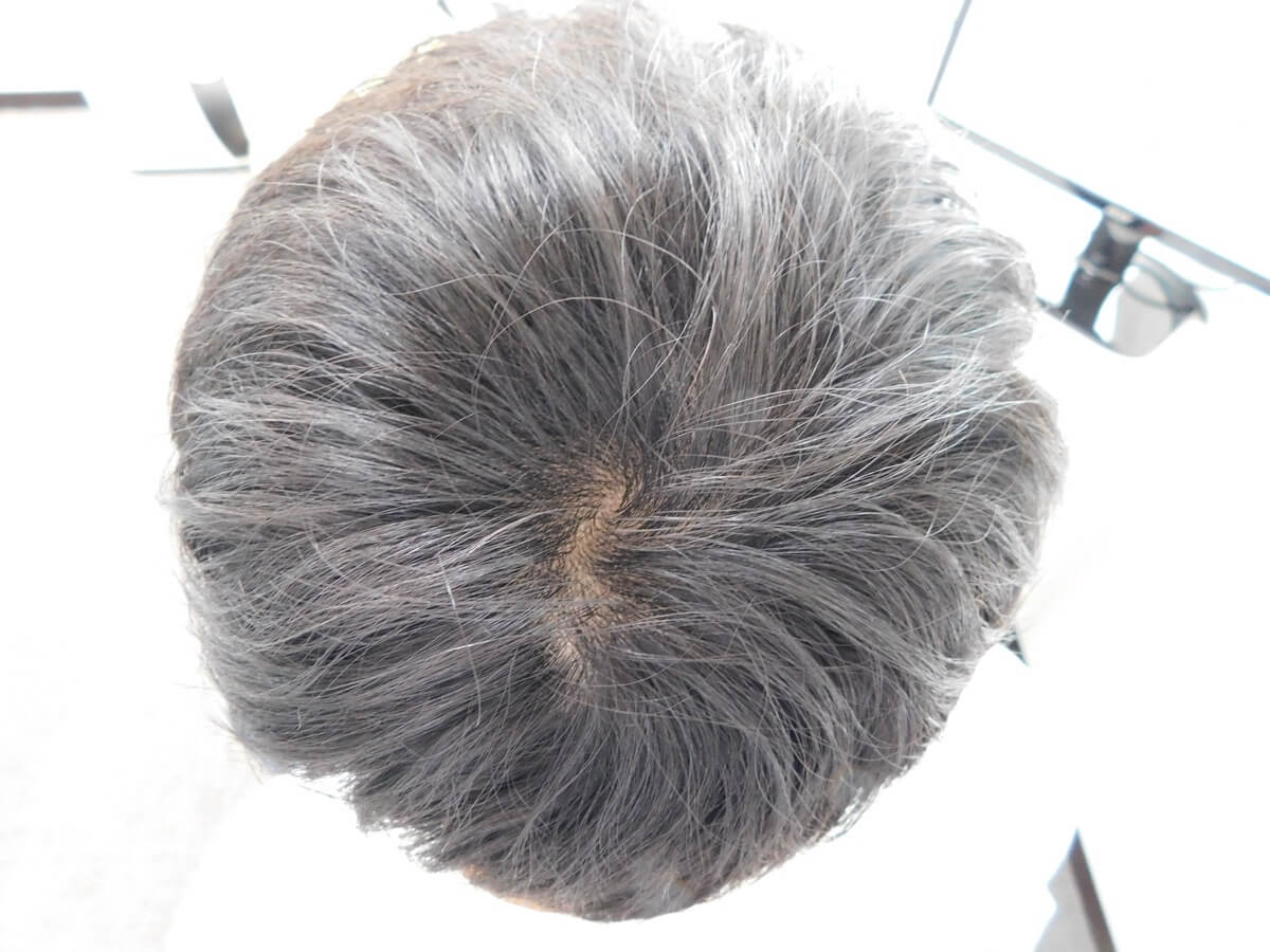 薄毛の改善事例（20代男性・3ヶ月後）