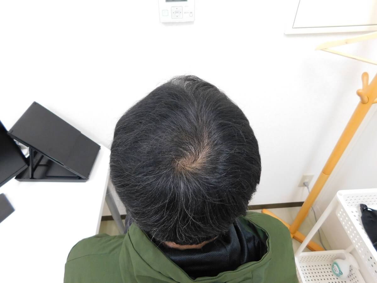 山形県南陽市で実績豊富なAGAクリニックの薄毛改善事例（40代男性・9ヶ月後）