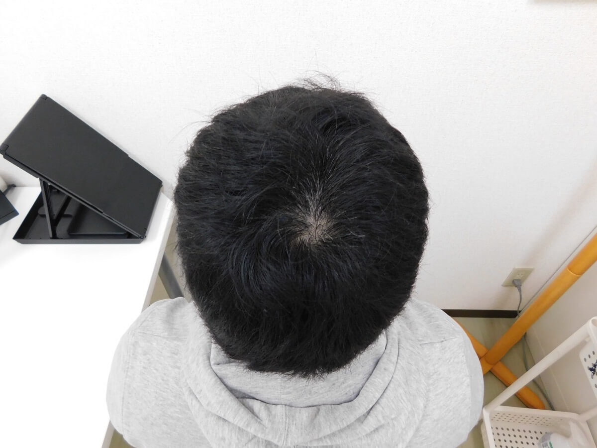 薄毛の改善事例（30代男性・6ヶ月後）