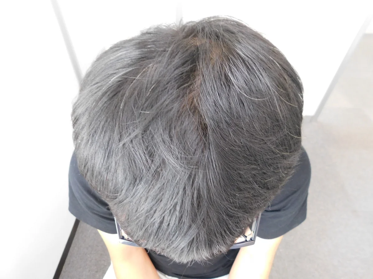 山形県上山市で実績豊富なAGAクリニックの薄毛改善事例（30代男性・5ヶ月後）