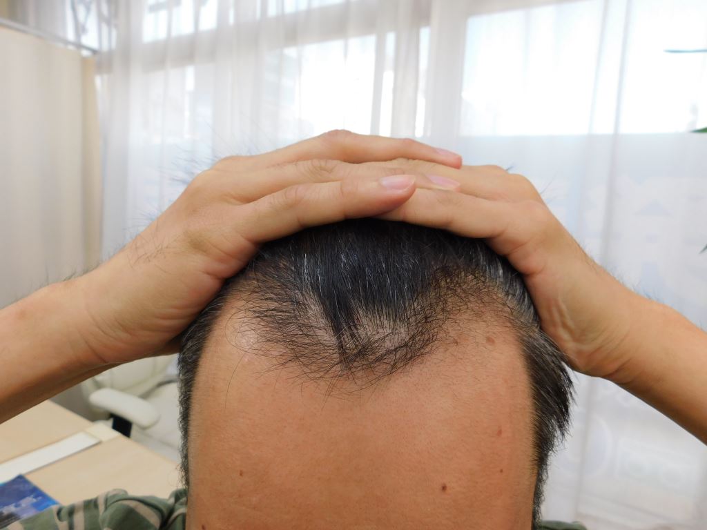 山形県上山市で実績豊富なAGAクリニックの薄毛改善事例（40代男性・5ヶ月後）