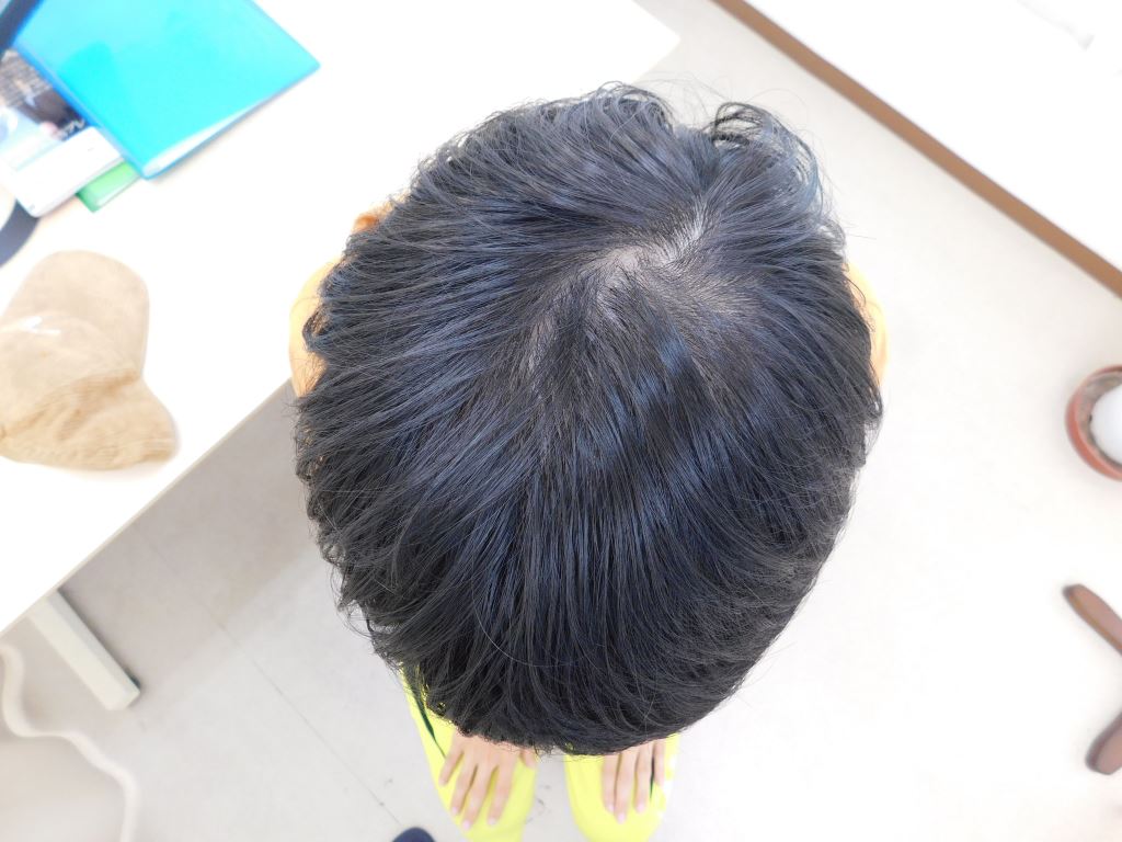 山形県上山市で実績豊富なAGAクリニックの薄毛改善事例（20代男性・8ヶ月後）